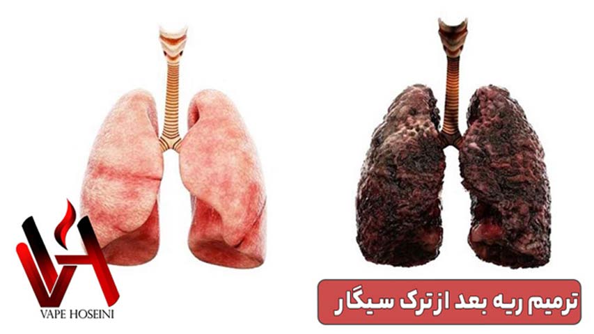 ترمیم ریه بعد از ترک سیگار